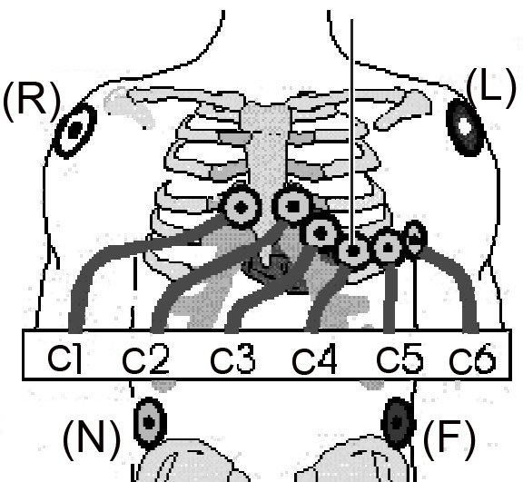 12 leads ECG electrodes placement IEC